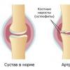 Ortopedinis kelio įtvaras sergant artroze: tipai, kaina, parinkimo ir veikimo taisyklės